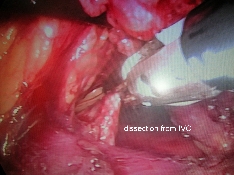 DISSECTION FROM IVC